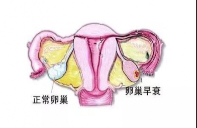 广州备孕试管婴儿知识_为什么年轻女性也会卵巢早衰？如何防止早衰？